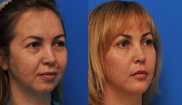 prima e dopo il ringiovanimento della pelle con rassodamento Foto 1