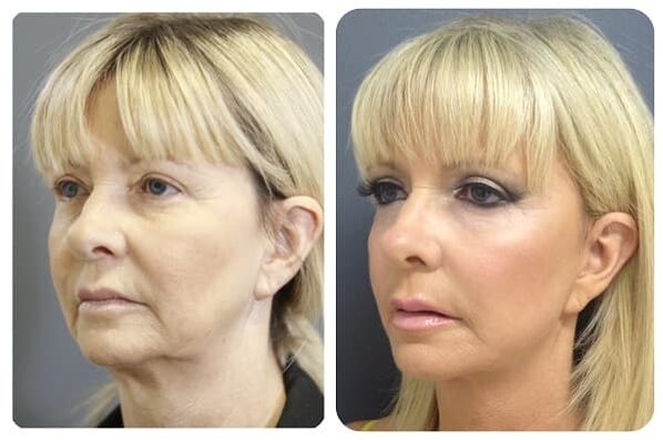 prima e dopo il ringiovanimento della pelle con rassodamento Foto 2